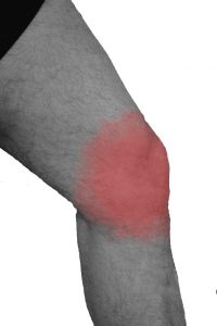 Beispiel einer der vielen Laufverletzungen am Knie