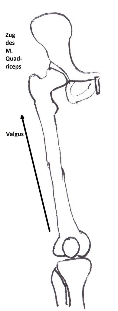 Kniescheibenfehlstellung durch natürliche Valgusstellung der unteren Extremität und des Zugs des M. quadriceps