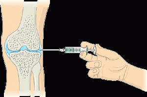 Hyaluronsäure Injektion bei einem arthrotischen Knie