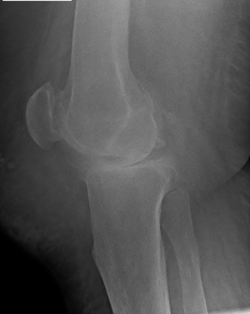 Röntgenbild einer Chondropathia patellae