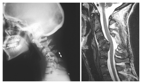 Röntgenbild eines verschobenen Facettengelenke